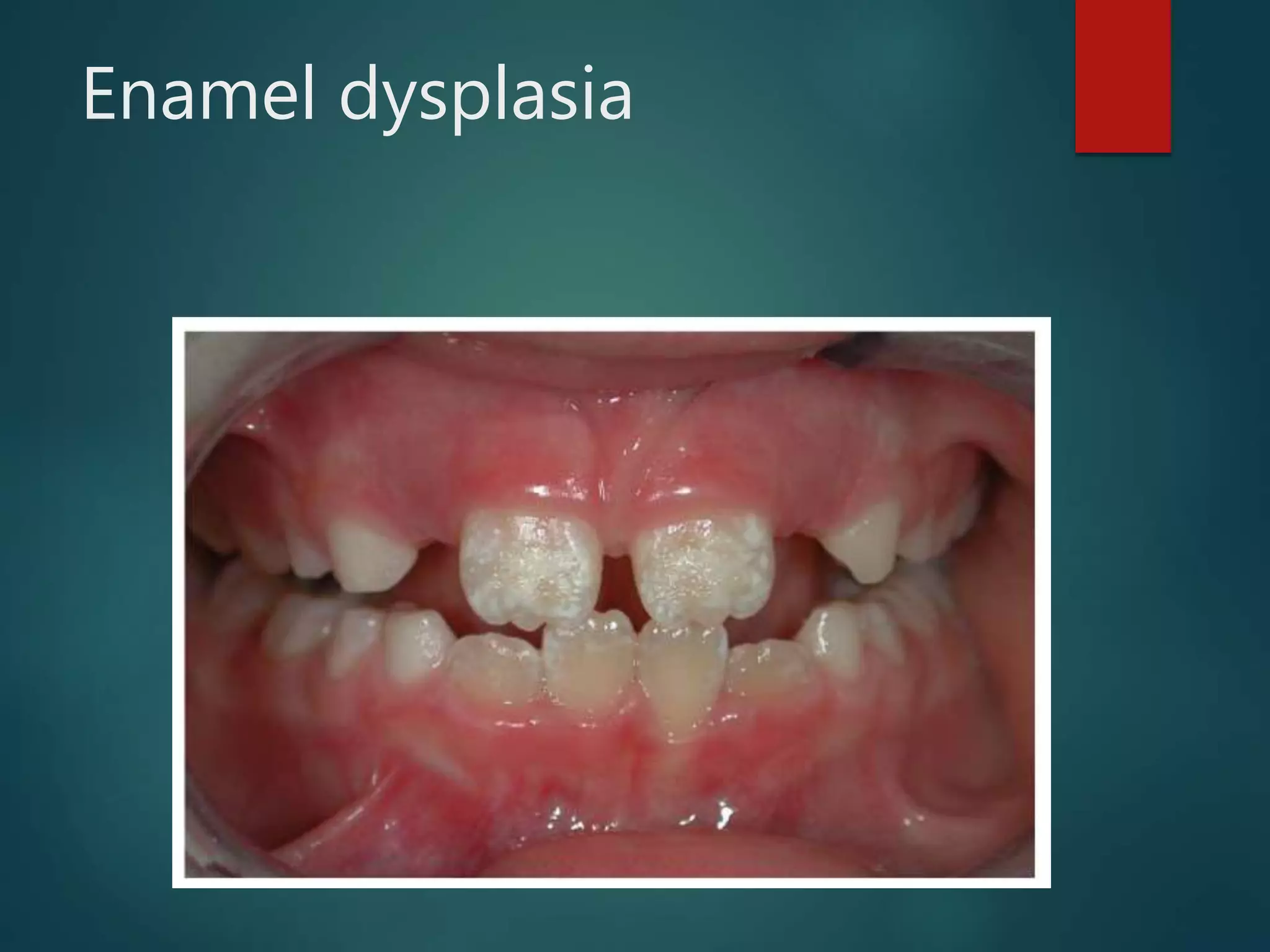Enamel dysplasia
 