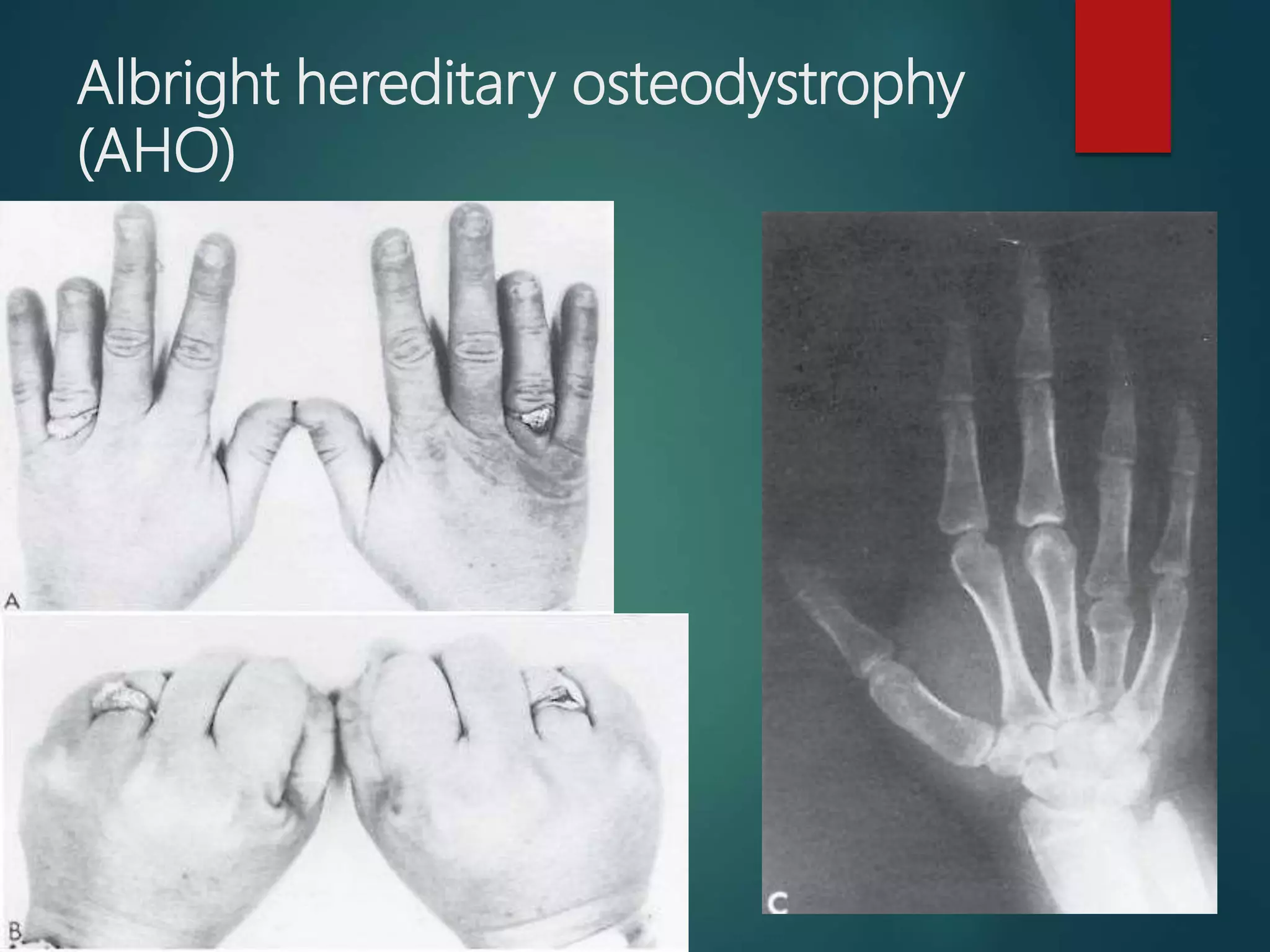 Albright hereditary osteodystrophy
(AHO)
 