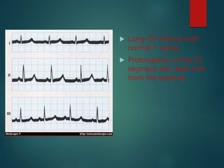  Long QT interval with
normal T waves
 Prolongation of the ST
segment with little shift
from the baseline
 