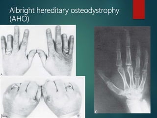 Albright hereditary osteodystrophy
(AHO)
 