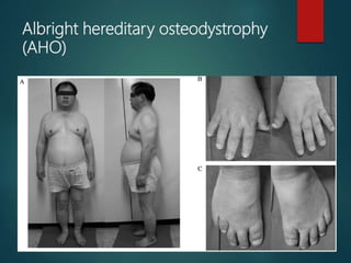 Albright hereditary osteodystrophy
(AHO)
 