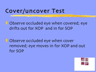 Cover/uncover Test Observe occluded eye when covered; eye drifts out for XOP  and in for SOP Observe occluded eye when cover removed; eye moves in for XOP and out for SOP 