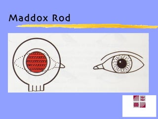 Maddox Rod 