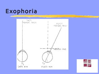 Exophoria  