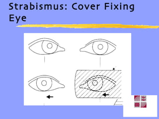 Strabismus: Cover Fixing Eye 