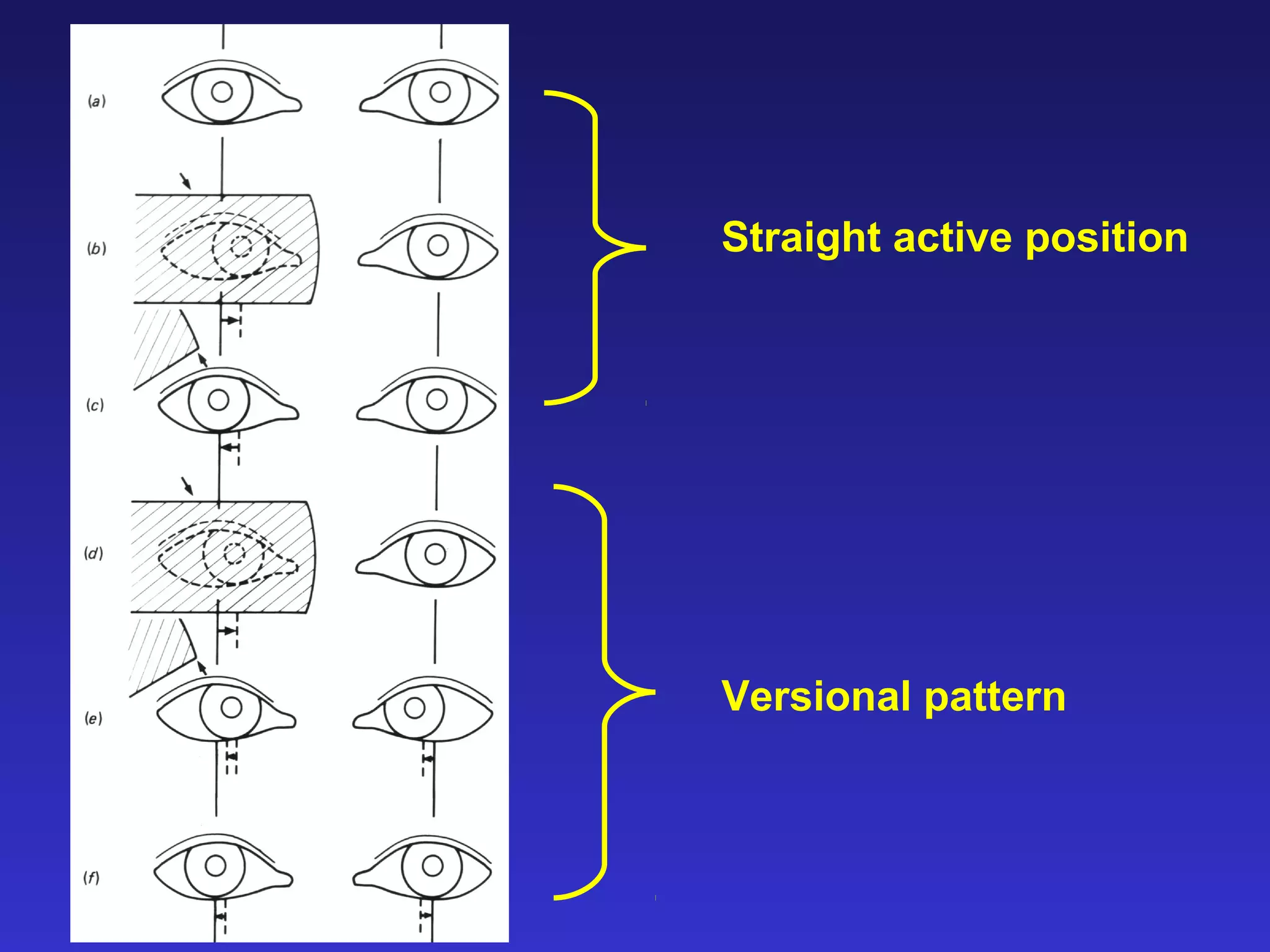 Straight active position
Versional pattern
 