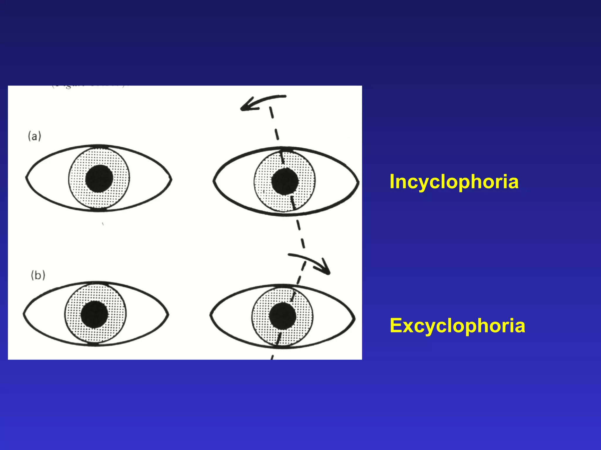 Incyclophoria
Excyclophoria
 