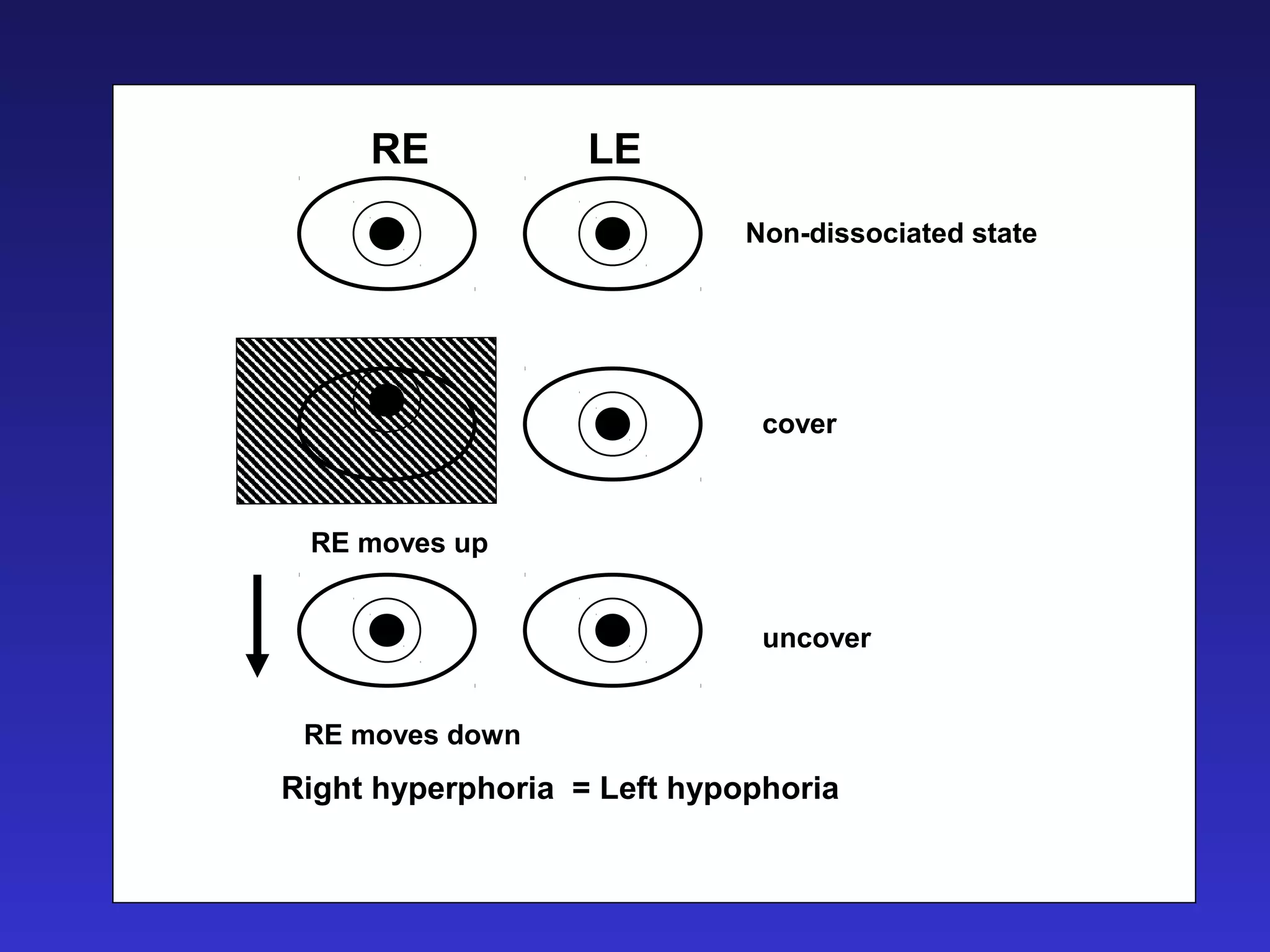 RE LE
Non-dissociated state
cover
uncover
RE moves up
RE moves down
Right hyperphoria = Left hypophoria
 