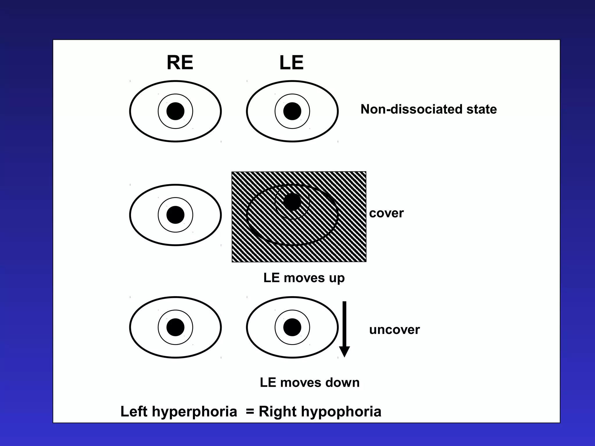 RE LE
Non-dissociated state
cover
uncover
LE moves up
LE moves down
Left hyperphoria = Right hypophoria
 