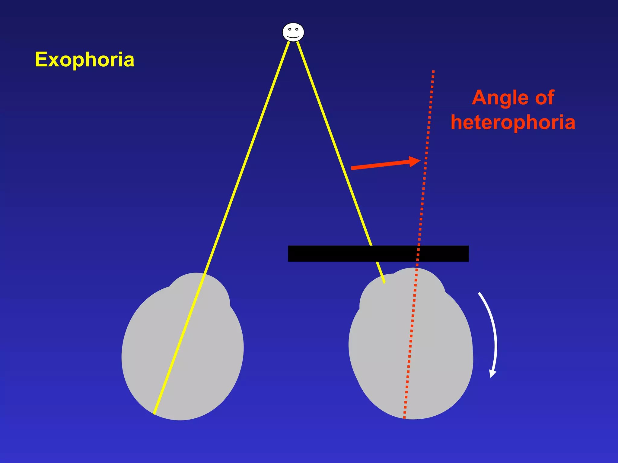 Angle of
heterophoria
Exophoria
 