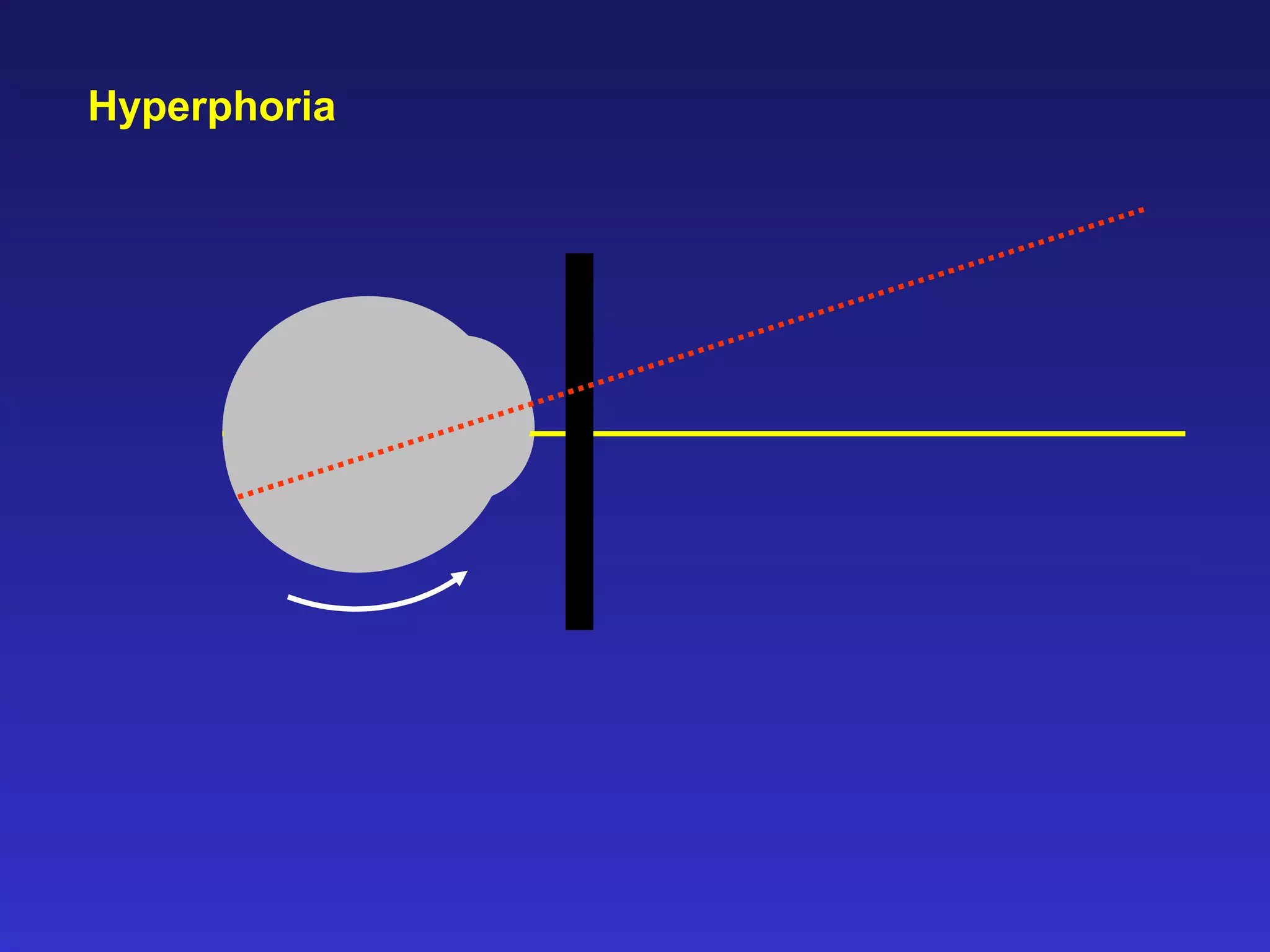 Hyperphoria
 