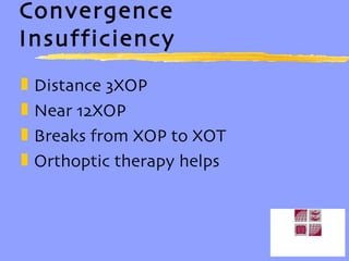 Convergence Insufficiency Distance 3XOP Near 12XOP Breaks from XOP to XOT Orthoptic therapy helps 