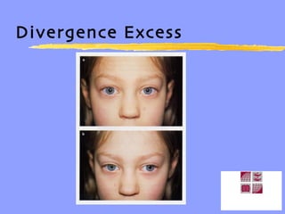 Divergence Excess 