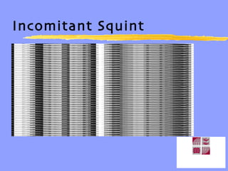 Incomitant Squint 