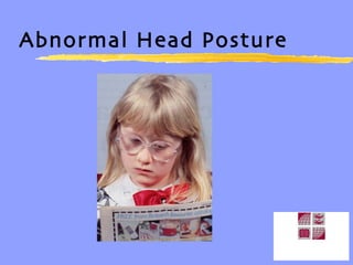 Abnormal Head Posture 