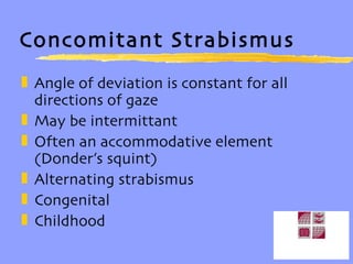Concomitant Strabismus Angle of deviation is constant for all directions of gaze May be intermittant Often an accommodative element (Donder’s squint) Alternating strabismus Congenital Childhood 