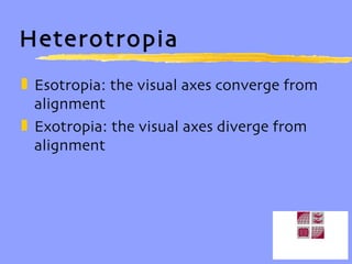 Heterotropia Esotropia: the visual axes converge from alignment Exotropia: the visual axes diverge from alignment 