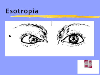 Esotropia 