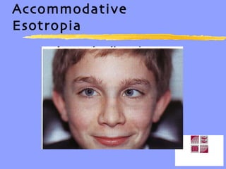 Accommodative Esotropia 