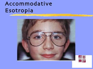 Accommodative Esotropia 