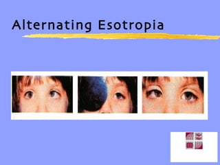 Alternating Esotropia 