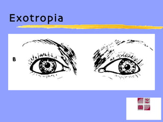 Exotropia 