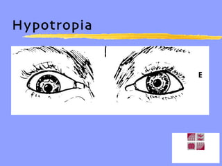Hypotropia 
