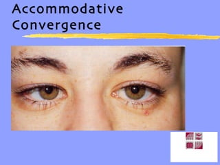 Accommodative Convergence 