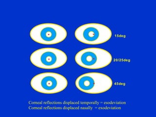 15deg 20/25deg 45deg Corneal reflections displaced temporally = esodeviation Corneal reflections displaced nasally  = exodeviation 