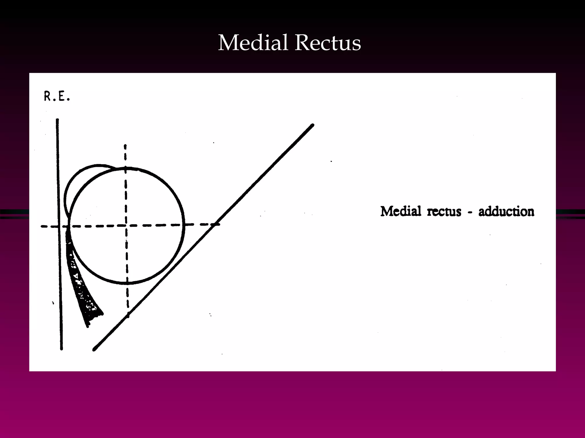 Medial Rectus 