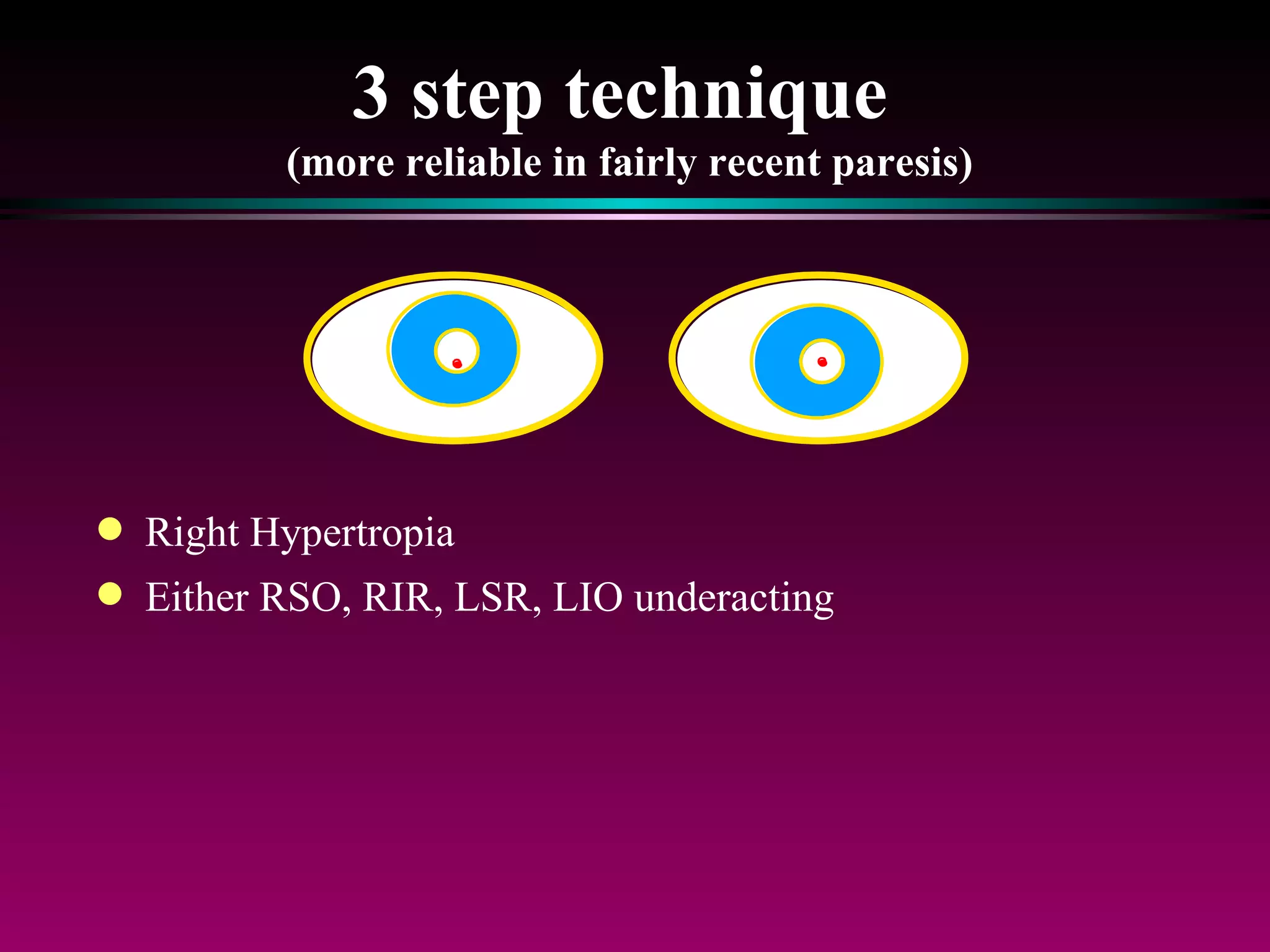 3 step technique  (more reliable in fairly recent paresis) Right Hypertropia Either RSO, RIR, LSR, LIO underacting 