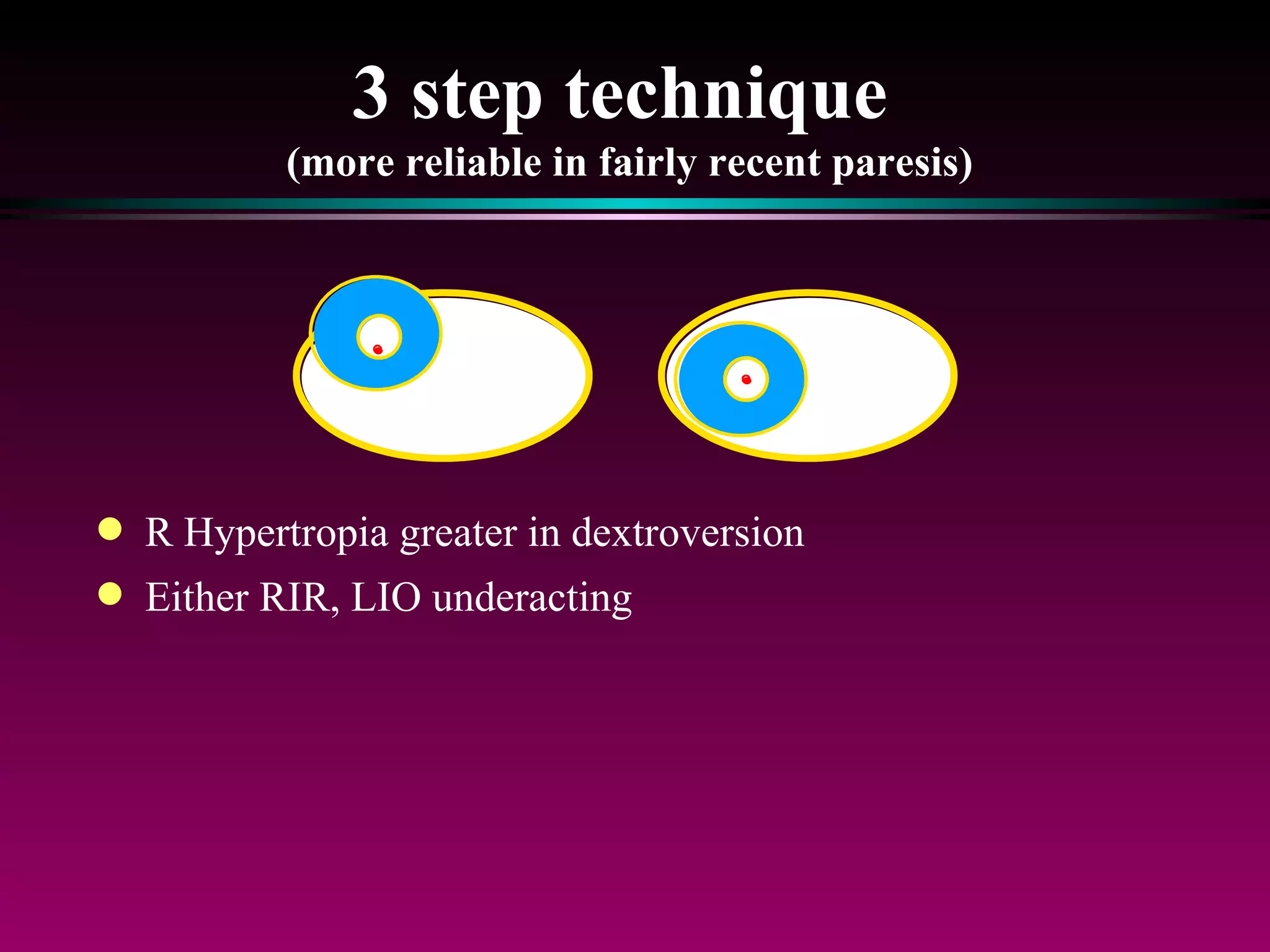 3 step technique  (more reliable in fairly recent paresis) R Hypertropia greater in dextroversion  Either RIR, LIO underacting 