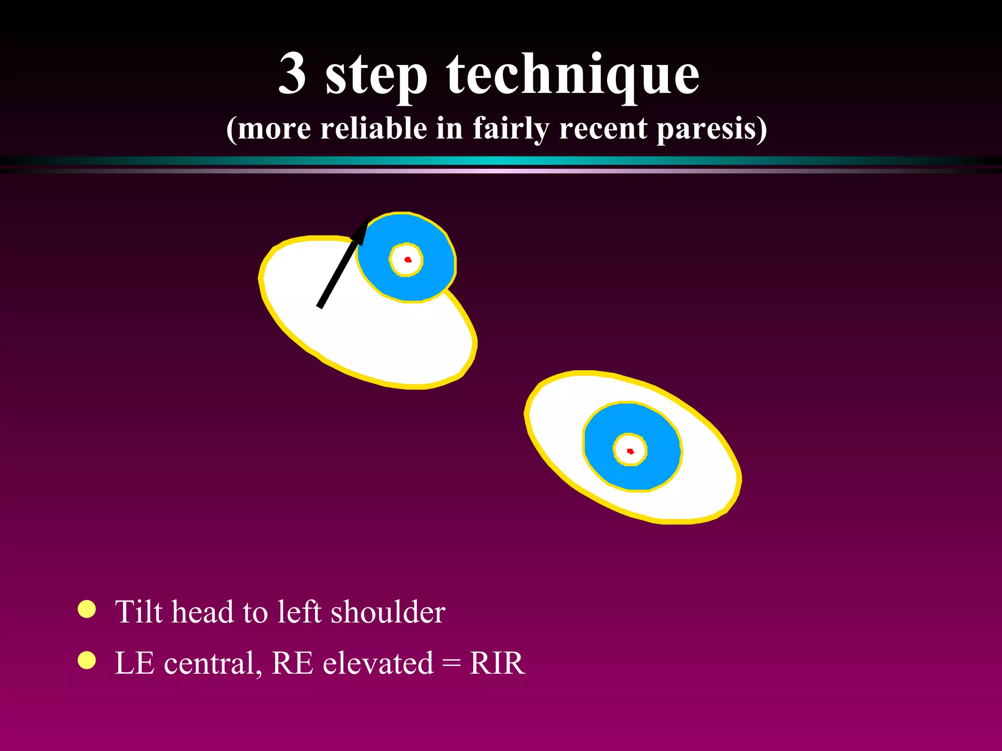 3 step technique  (more reliable in fairly recent paresis) Tilt head to left shoulder  LE central, RE elevated = RIR 