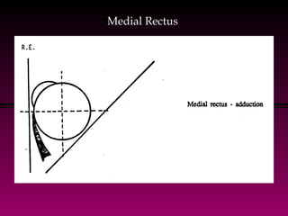 Medial Rectus 