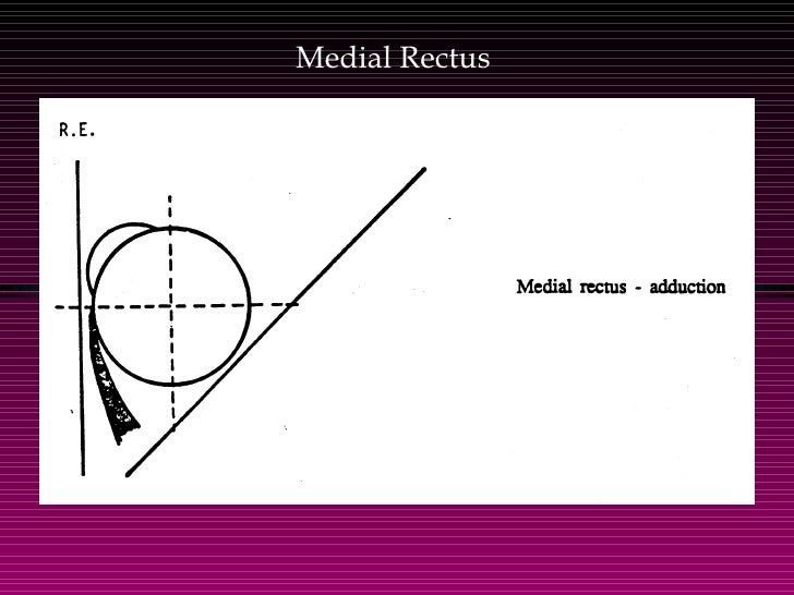 paralytic strabismus