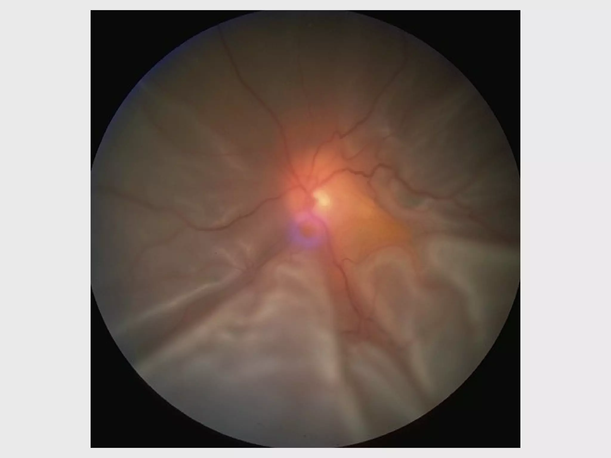 DISORDERS OF THE VITREOUS AND RETINAL DETACHMENT | PPT