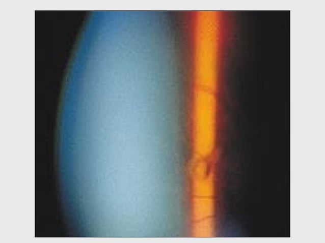 DISORDERS OF THE VITREOUS AND RETINAL DETACHMENT | PPT | Eye and Vision ...