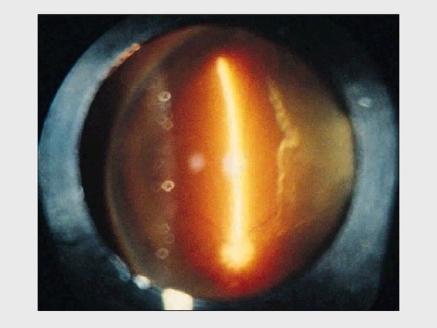 DISORDERS OF THE VITREOUS AND RETINAL DETACHMENT | PPT | Eye and Vision ...