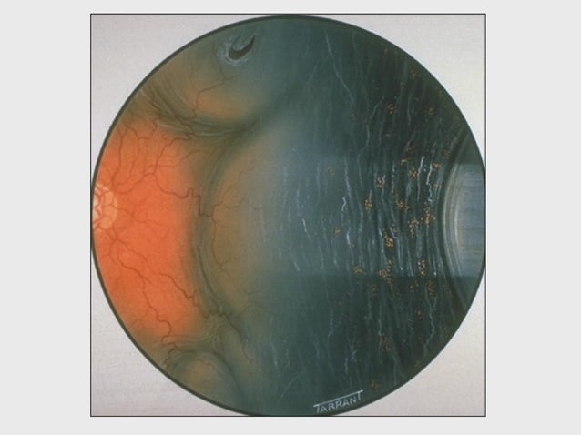 DISORDERS OF THE VITREOUS AND RETINAL DETACHMENT | PPT | Eye and Vision ...