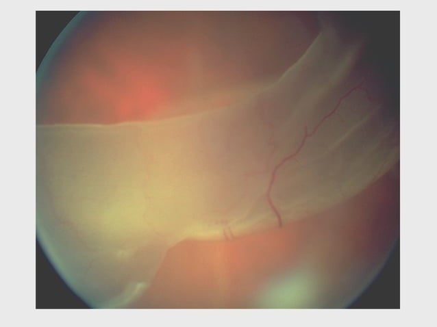 DISORDERS OF THE VITREOUS AND RETINAL DETACHMENT | PPT | Eye and Vision ...