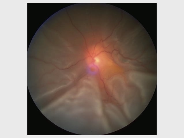 DISORDERS OF THE VITREOUS AND RETINAL DETACHMENT | PPT | Eye and Vision ...