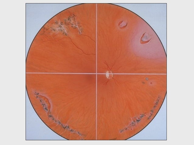 DISORDERS OF THE VITREOUS AND RETINAL DETACHMENT | PPT | Eye and Vision ...