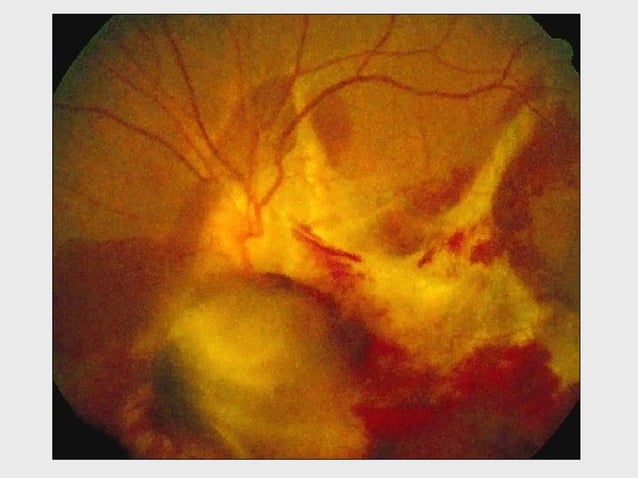 DISORDERS OF THE VITREOUS AND RETINAL DETACHMENT | PPT | Eye and Vision ...