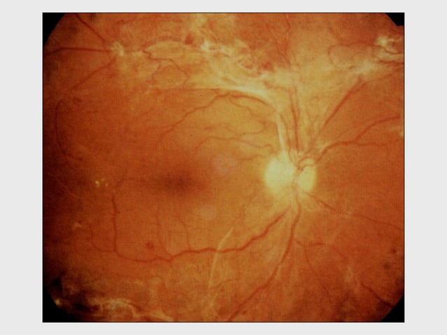 DISORDERS OF THE VITREOUS AND RETINAL DETACHMENT | PPT | Eye and Vision ...