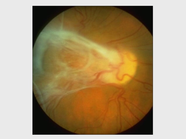 DISORDERS OF THE VITREOUS AND RETINAL DETACHMENT | PPT | Eye and Vision ...