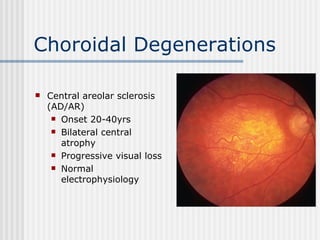 Choroidal Degenerations Central areolar sclerosis (AD/AR) Onset 20-40yrs Bilateral central atrophy Progressive visual loss Normal electrophysiology 