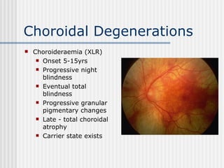 Choroidal Degenerations Choroideraemia (XLR) Onset 5-15yrs Progressive night blindness Eventual total blindness Progressive granular pigmentary changes Late - total choroidal atrophy Carrier state exists 