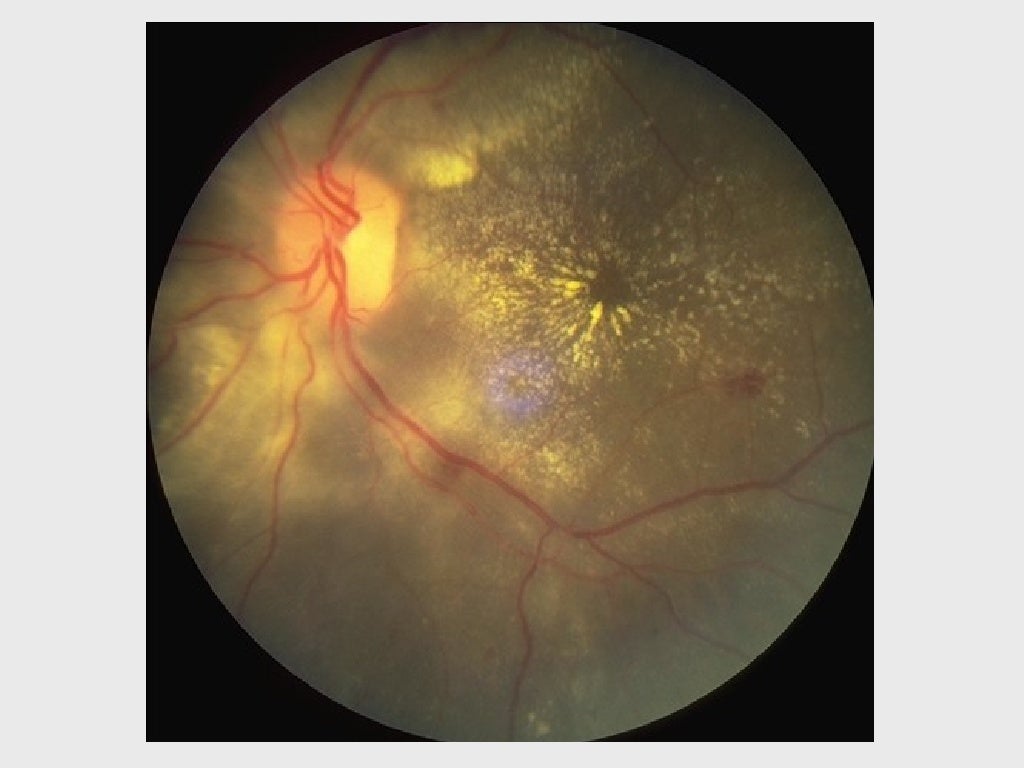 VASCULAR AND HEREDITARY RETINAL DISEASE