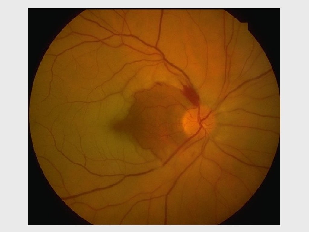 VASCULAR AND HEREDITARY RETINAL DISEASE