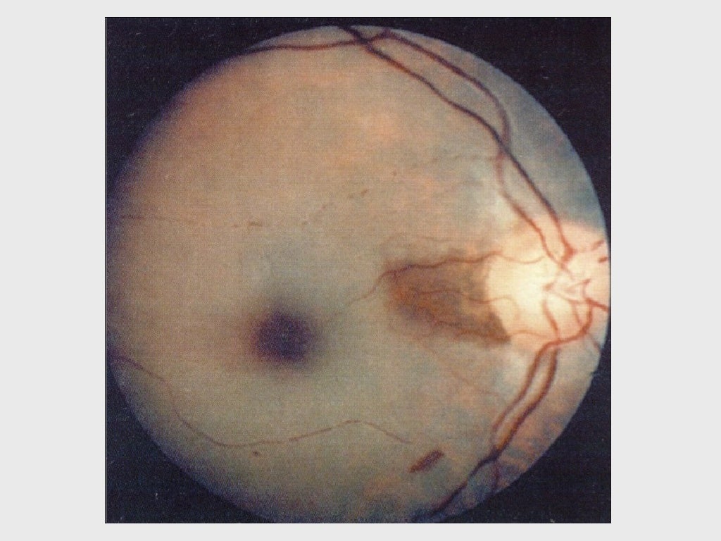 VASCULAR AND HEREDITARY RETINAL DISEASE